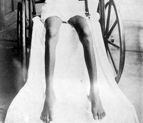 The legs of someone with Beri Beri disease; their legs are thin and they are sitting in a wheelchair.